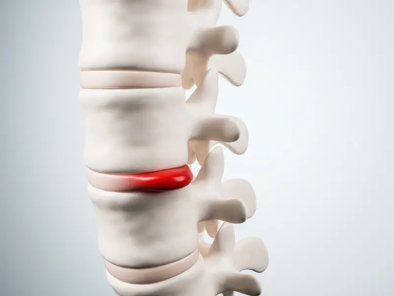 Disc Injury Treatment Near Me in East Greenwich, RI. Chiropractor For Disc Injury Pain Relief.