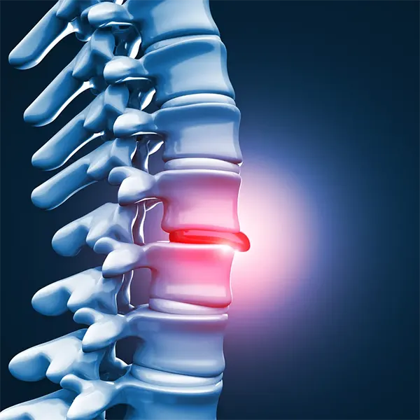 Disc Injury Treatment Near Me in East Greenwich, RI. Chiropractor For Disc Injury Pain Relief.